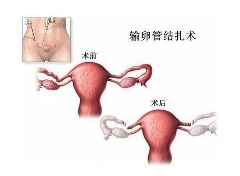 取卵手术